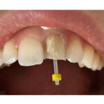 Dental Fiber Post Kit (Pack of 20 Posts + 4 Drills) - Image 5