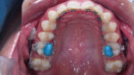 Anabond Blu-Bite - Image 4
