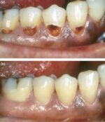 Prevest Crysta Restorative II GIC - Image 6