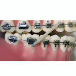 OrthoMetric Advanced Series Bondable Molar Tubes MBT022 (Pack of 10) - Image 5
