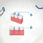 U Ortho Separators - Image 5