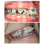 U Ortho NiTi Open Spring 0.010 Inch 180mm - Image 7