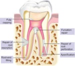 SafeEndo BioStructure MTA - Image 3