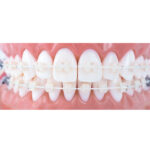 U ortho Niti Tooth Color Wire-Rectangular (Pack of 1) - Image 12