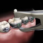 Gdc Posterior Band Remover # Short (Tc) (3000/49Tc) - Image 4