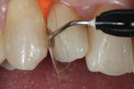 SafeEndo ReCreate LC Flow - Image 6