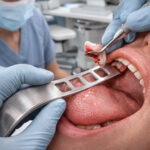 GDC Tongue Depressor # Bruenings 19cm TRB - Image 5