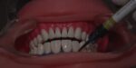 Prevest Florence Teeth Whitening Kit- 1 Patient - Image 7