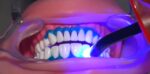 Prevest Florence Teeth Whitening Kit- 1 Patient - Image 8