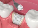 B-Ostin HA Nano Bonegraft Materials 0.355 - 0.500mm - Image 4