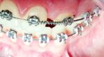 U Ortho NiTi Open Spring 0.010 Inch 180mm - Image 9