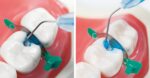 SafeEndo Smart Etch 5ml - Image 4