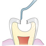 GDC ART Atraumatic Restorative Treatment Instrument (ART3 # 6) - Image 3