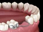 Kids-e-Dental Space Maintainer All in one starter kit - Image 6