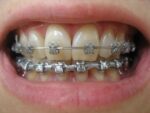 U Ortho E-Chain (15 ft) - Long Grey - Image 4