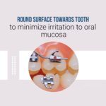 UU Ortho Premium Bondable Buccal Tubes MBT (Pack of 20 Sets) - Image 24