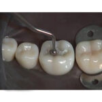 GDC Ball Burnisher - 3 (Bb22/23) - Image 5
