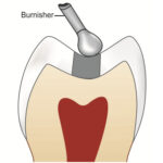 GDC Ball Burnisher - 3 (Bb22/23) - Image 4