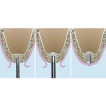 GDC Osteotomes Concave - Angulated (Ostmsh42a) - Image 3