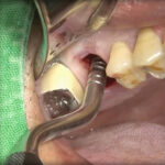 GDC Osteotomes Concave - Angulated (Ostmsh42a) - Image 4