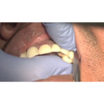 GDC Automatic Crown Remover Standard (CRS) - Image 10