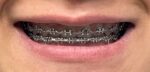 U Ortho E-Chain (15 ft) - Short Grey - Image 6