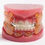 Dentomech Hard Steel Orthodontic Wire Pouch 10g - 22 Gauge ( 0.7 mm ) - Image 3