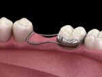 Kids-e-Dental Space Maintainer All in one starter kit - Image 7