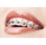 U Ortho Bracket Kit MBT 022 - Image 2
