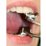 GDC Ferguson Mouth Gag - Small (Fmgc) - Image 2