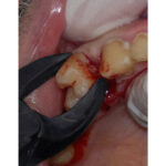 GDC Plasma Black Extraction Forceps Upper Premolar #7 (FX7B) - Image 4