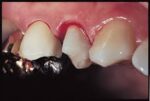 Prevest Hemostal Gel - Image 3
