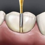 Prima Dental Predator Accuprep Crown Preparation Carbides Kit - Image 5