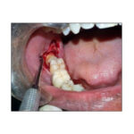GDC Impaction Kit with Sterilization Box (OSIWC22) - Image 3
