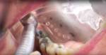 Waldent Maxbite Intraoral Lighting - Image 21