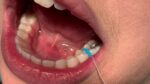 U Ortho Separators - Image 7