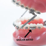 OSL 1st Molar Prewelded Molar Bands MBT 0.018 U2/L1 (Pack Of 4) - Image 5
