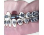 U Ortho NiTi Open Spring 0.010 Inch 180mm - Image 6