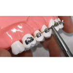 JJ Ortho NiTi Open Coil Spring 180mm (60.01.17) - Image 3