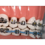 JJ Ortho NiTi Open Coil Spring 180mm (60.01.17) - Image 5