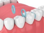 U Ortho Separators - Image 6