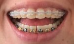 U Ortho E-Chain (15 ft) - Long White - Image 6