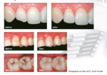 Shofu Beautifil II Dental Composite Basic Kit - Image 8