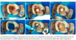 SafeEndo BioStructure MTA - Image 4