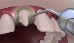 Prevest Hemostal Gel - Image 2