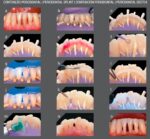 Angelus Interlig Single Patient Strip (Pack of 4) - Image 8