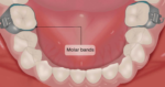 U Ortho Molar Bands Non-Convertible Mbt 0.022 2nd Molar (Pack of 4) - Image 7