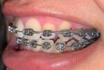 U Ortho E-Chain (15 ft) - Long Grey - Image 6