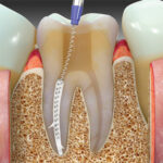 SafeEndo BioActive RCS - Image 5