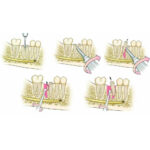 GDC Root Elevator Set Of 9 In Pouch (RESP9) - Image 3
